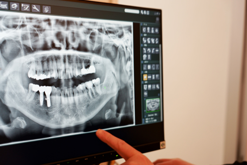 できるだけ早い治療の取り組み